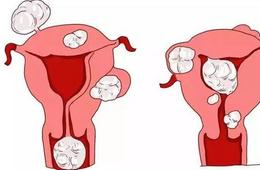 消除子宮肌瘤的3種方法