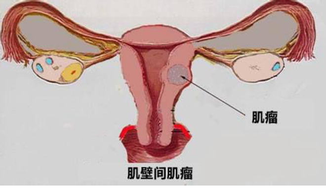 子宮肌瘤這個難題，預防看這6點