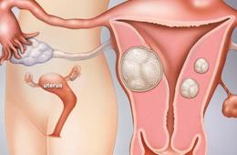 子宫肌瘤有哪些危害，如何预防？