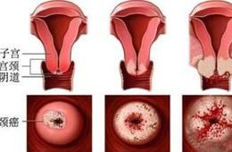 宫颈癌与男性有关系吗？