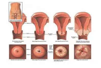 宫颈癌早期有这三处痒，发现了赶紧看医生
