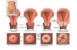 宮頸癌早期有這三處癢，發現了趕緊看醫生