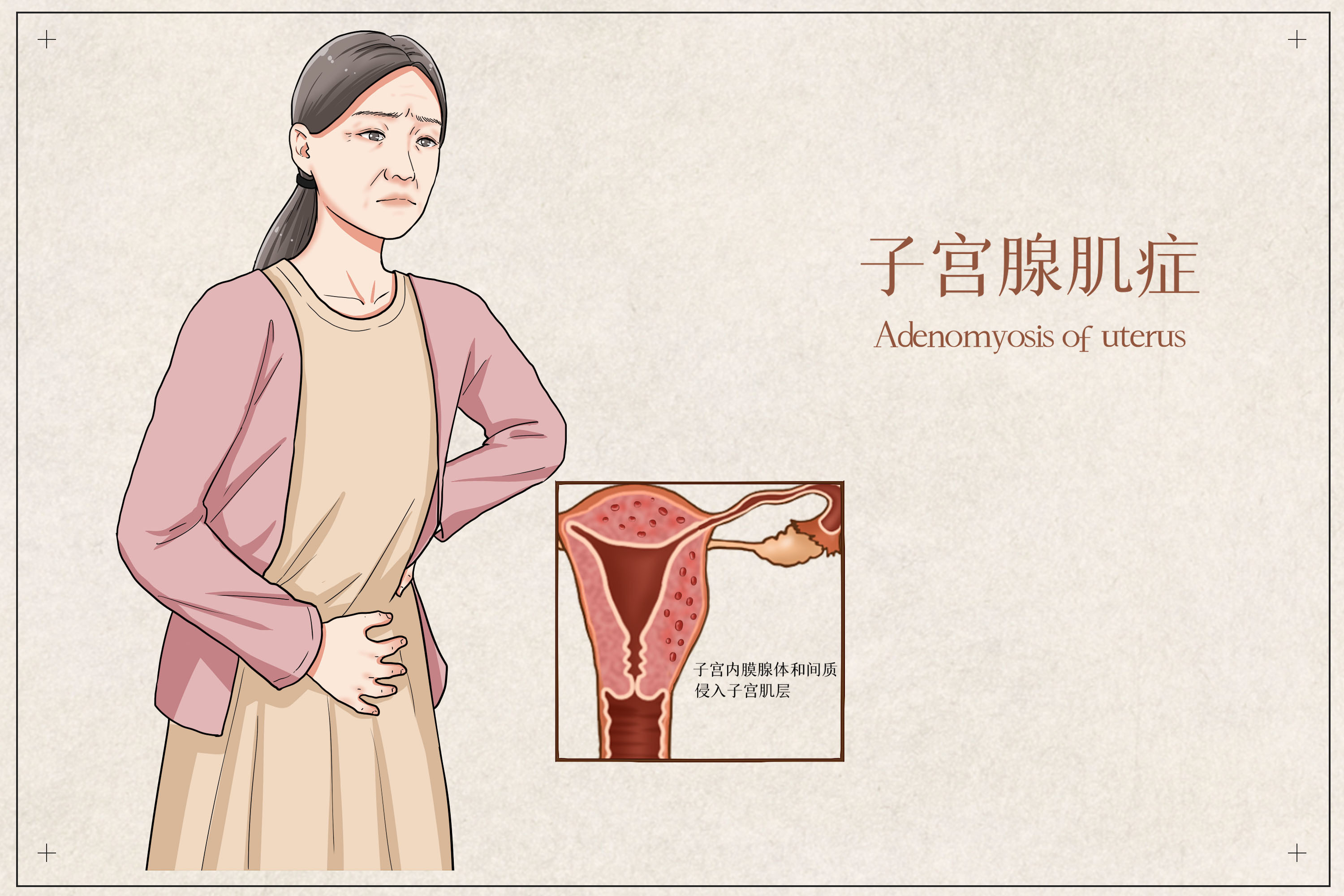 子宫腺肌症的五大症状，你中招了吗？