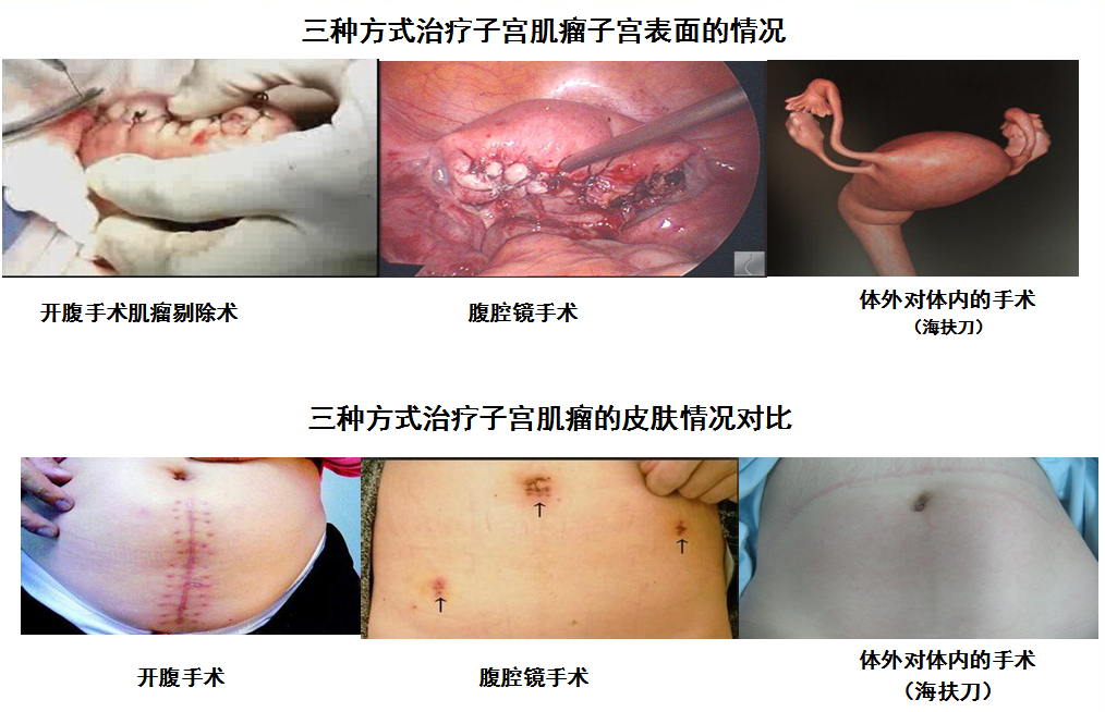 一天內消融40多個子宮肌瘤