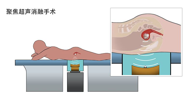 54歲肌瘤患者，開刀之后選海扶