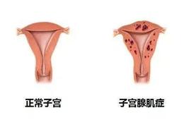 子宫腺肌病会癌变吗？