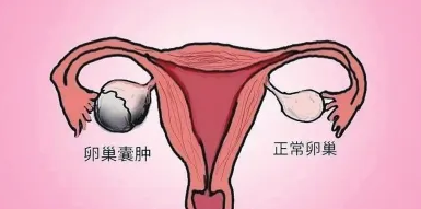 卵巢長囊腫了，該怎么辦？
