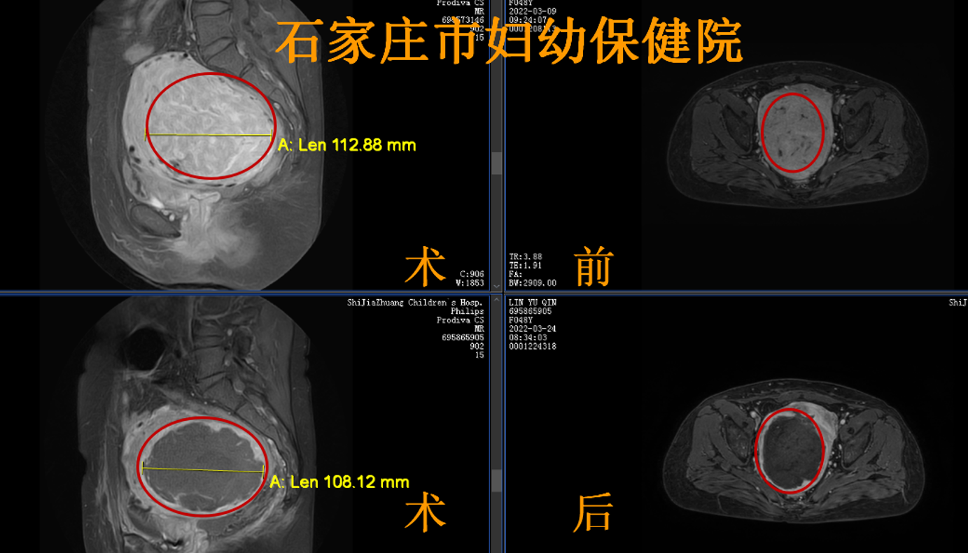 11公分子宮肌瘤，高難度手術被成功拿下！