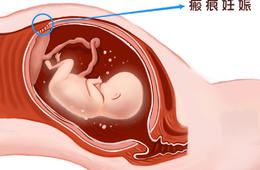 剖宮產瘢痕妊娠就是一個“炸彈”，看專家如何“拆彈”