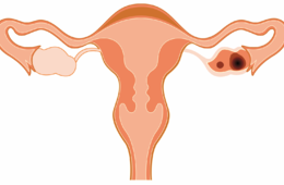 卵巢囊肿是什么原因引起的？