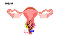 妇科炎症会引起宫颈癌吗？