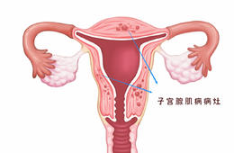 面對腺肌病，保護子宮是每一位女性的愿望