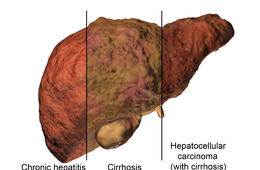 结肠癌肝转移，是结肠癌还是肝癌