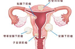 子宮肌瘤究竟長什么樣？
