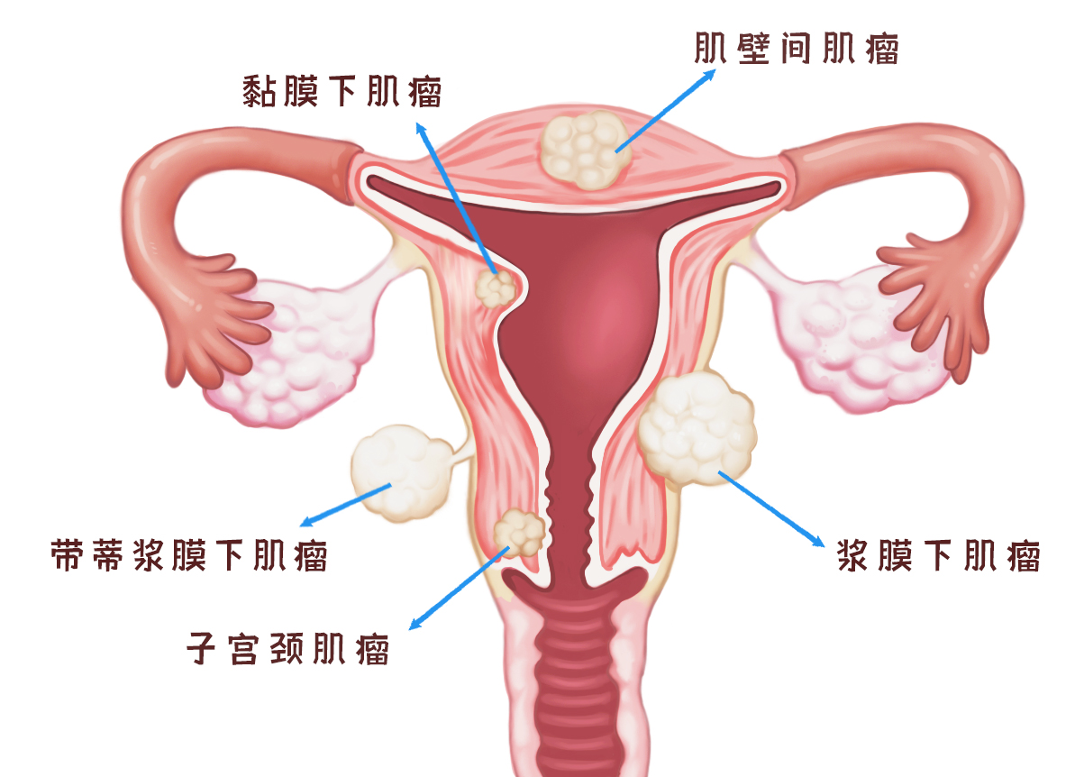 29歲的她體檢發現了子宮肌瘤