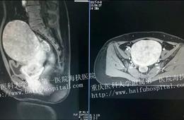 從非洲到重慶：她戰勝了10cm大肌瘤！